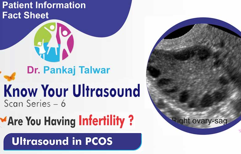 Ultrasound in PCOS