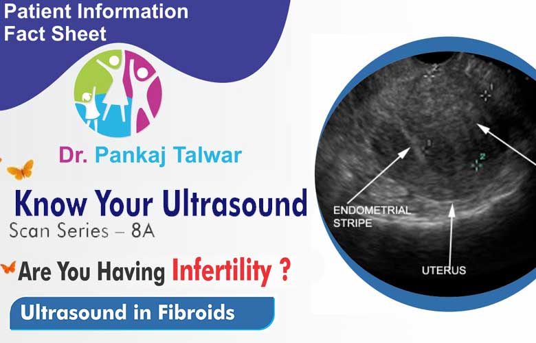 Ultrasound in Fibroids