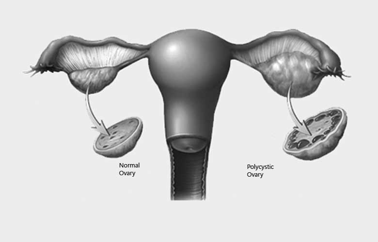 5 pcos 1