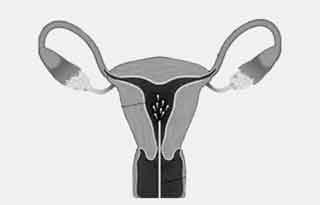 intra uterine insemination 1
