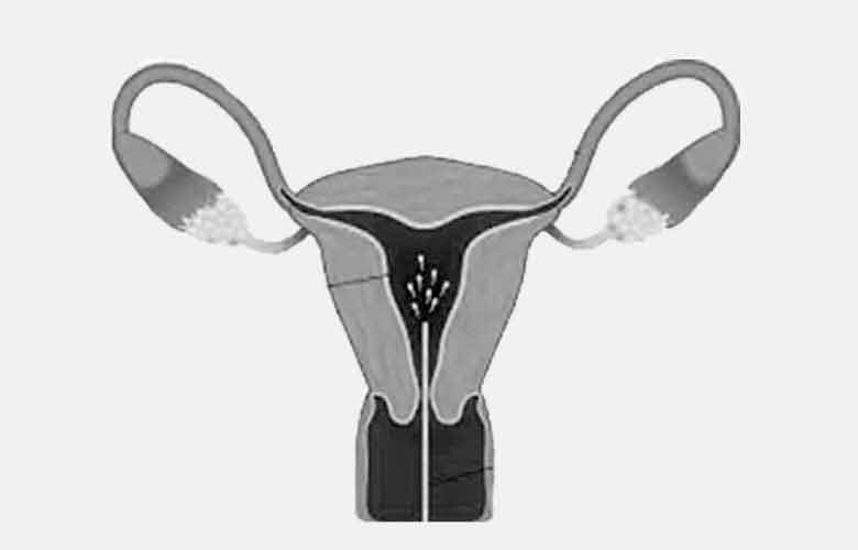 What is IUI