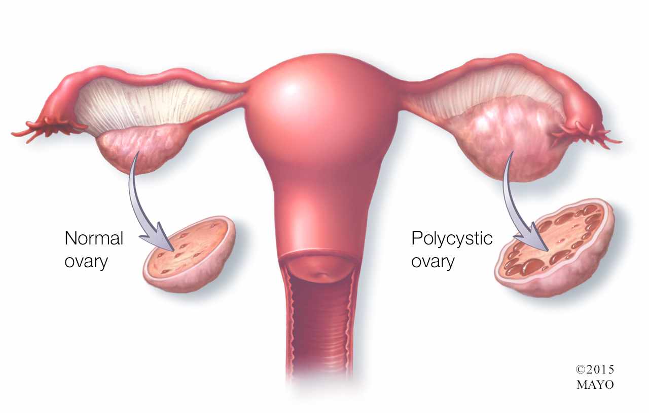 PCOS1