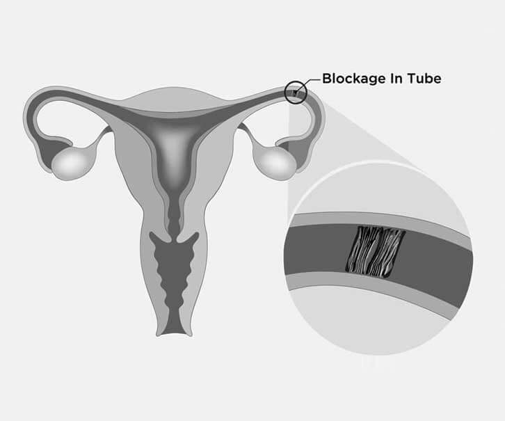 Fallopian tube blockage 1
