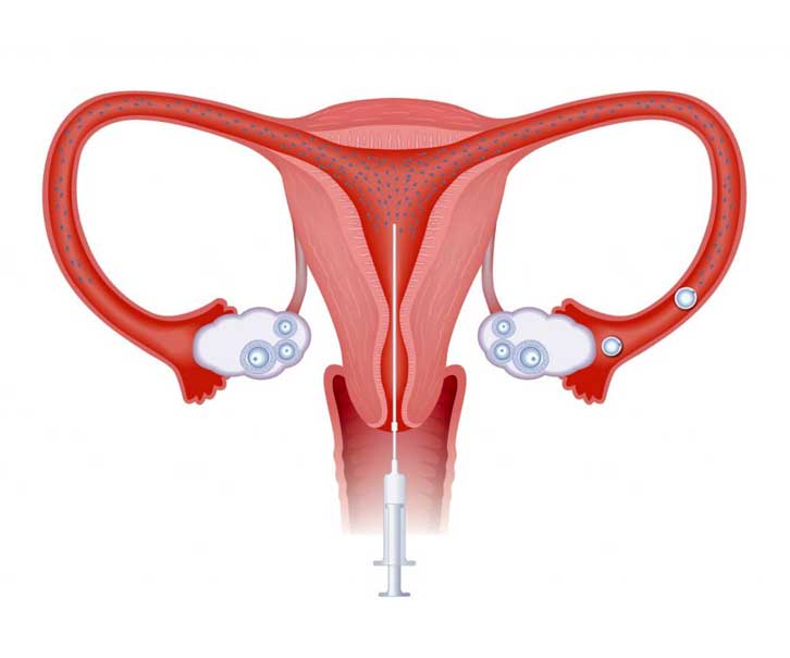 Intrauterine Insemination Treatment